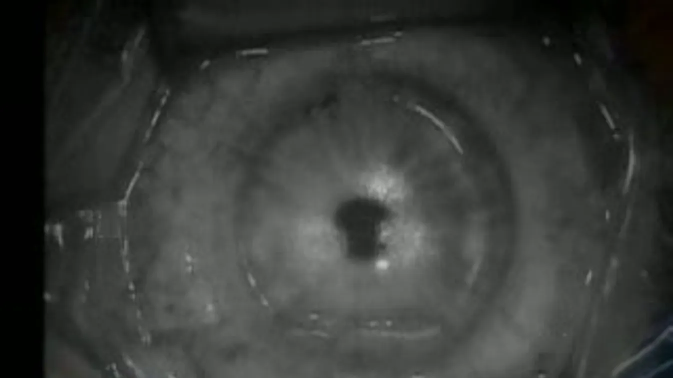 Élet olvasószemüveg nélkül – Gyógyhír