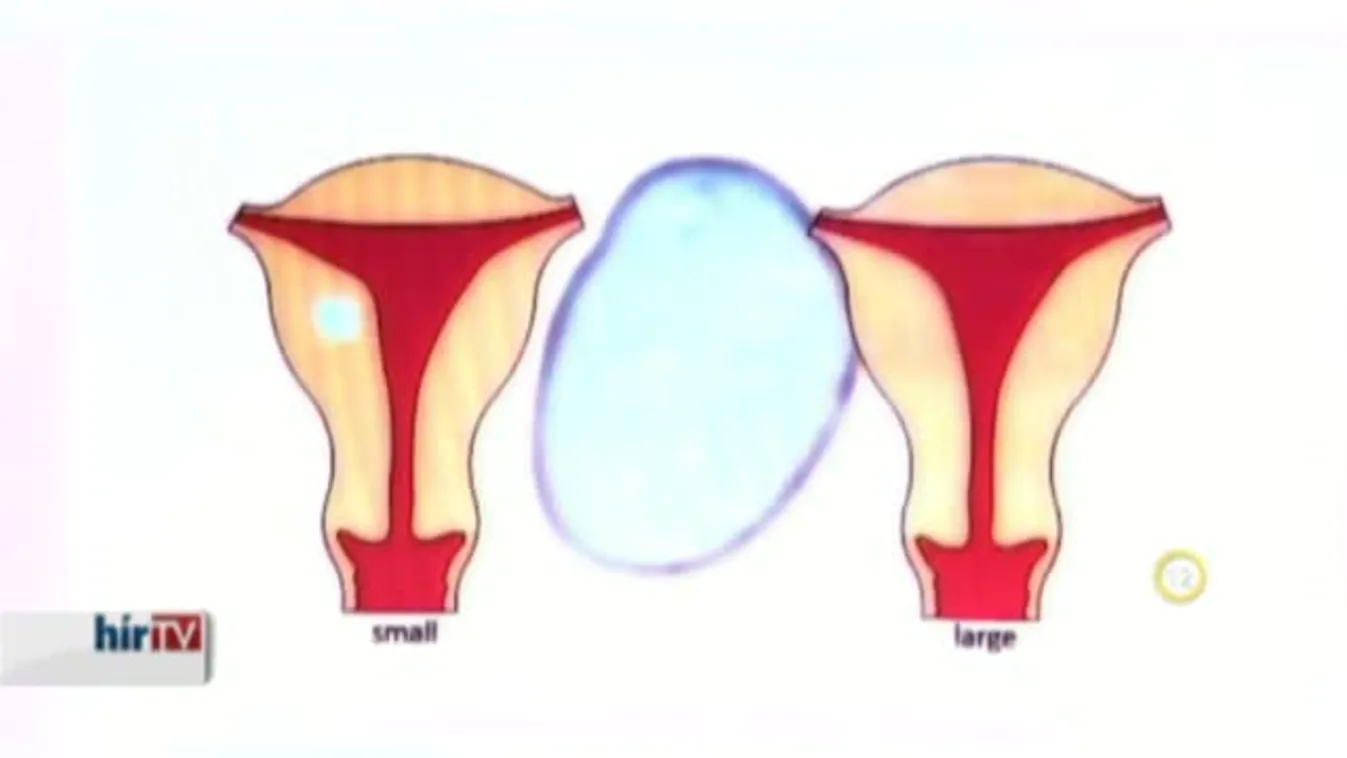 Gyógyhír – Mióma-kezelés