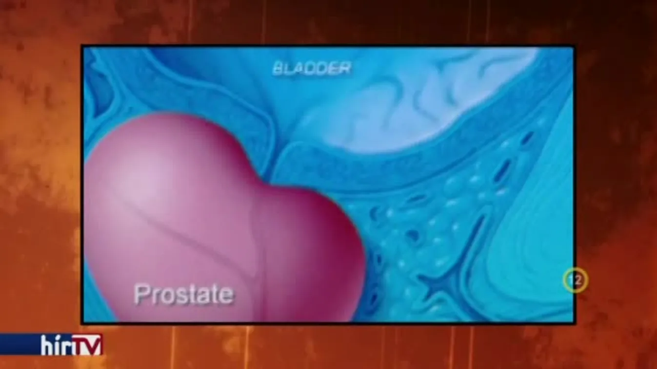 Gyógyhír - Prosztatadaganat