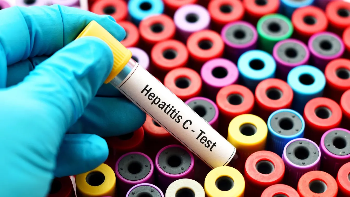 Ingyenes hepatitis C-szűrés lesz az országban több helyen