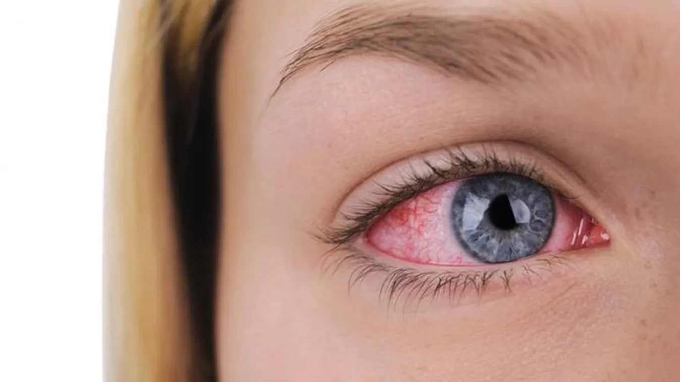 Népbetegség: viszket, könnyezik és vörösödik