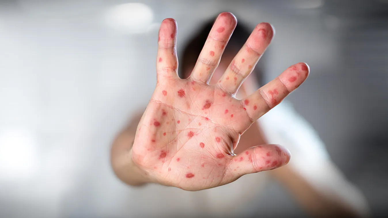 Szükséghelyzetet hirdettek Szamoán a járvány rohamos terjedése miatt