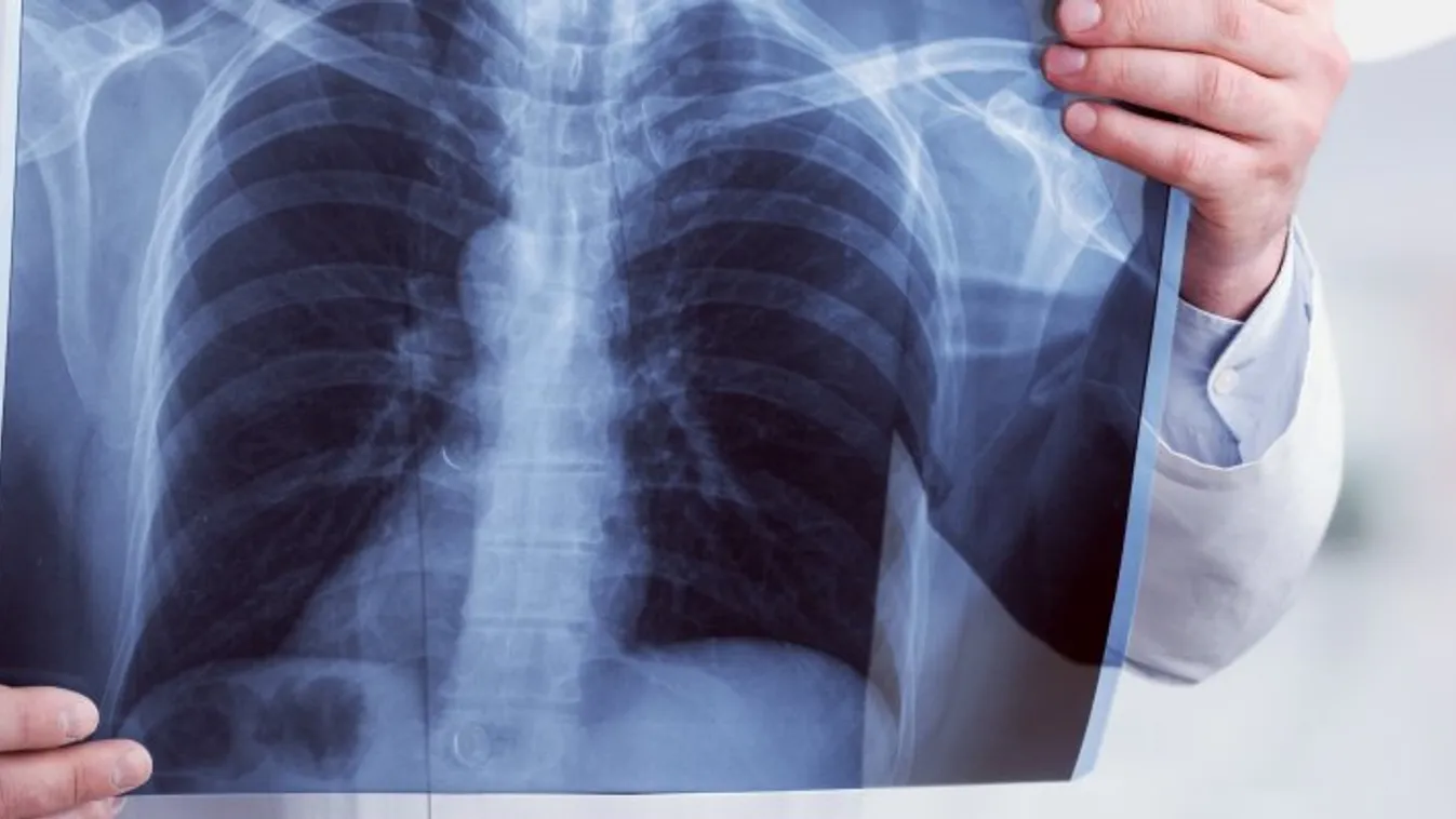 Bécsi orvosok végezték az első tüdőátültetést koronavírusos betegnél Európában