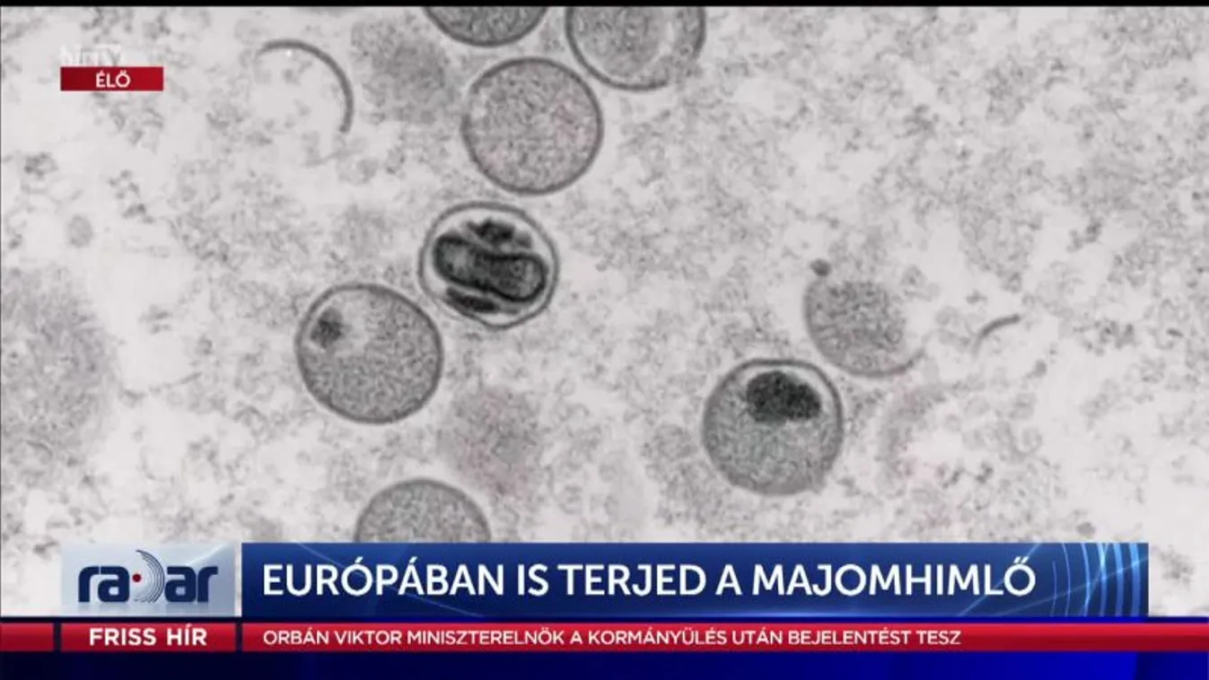 Radar - Európában is terjed a majomhimlő (2022-05-25)