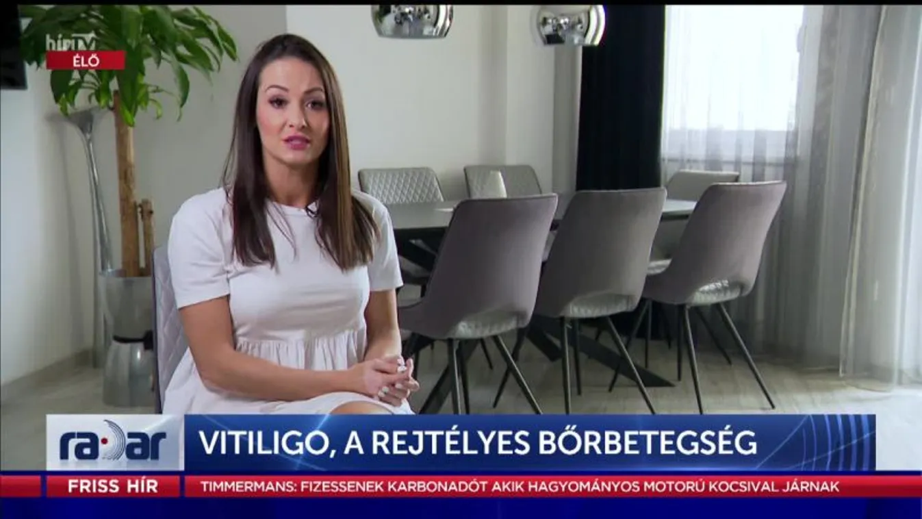 Radar - Vitiligo, a rejtélyes bőrbetegség (2022-06-07)