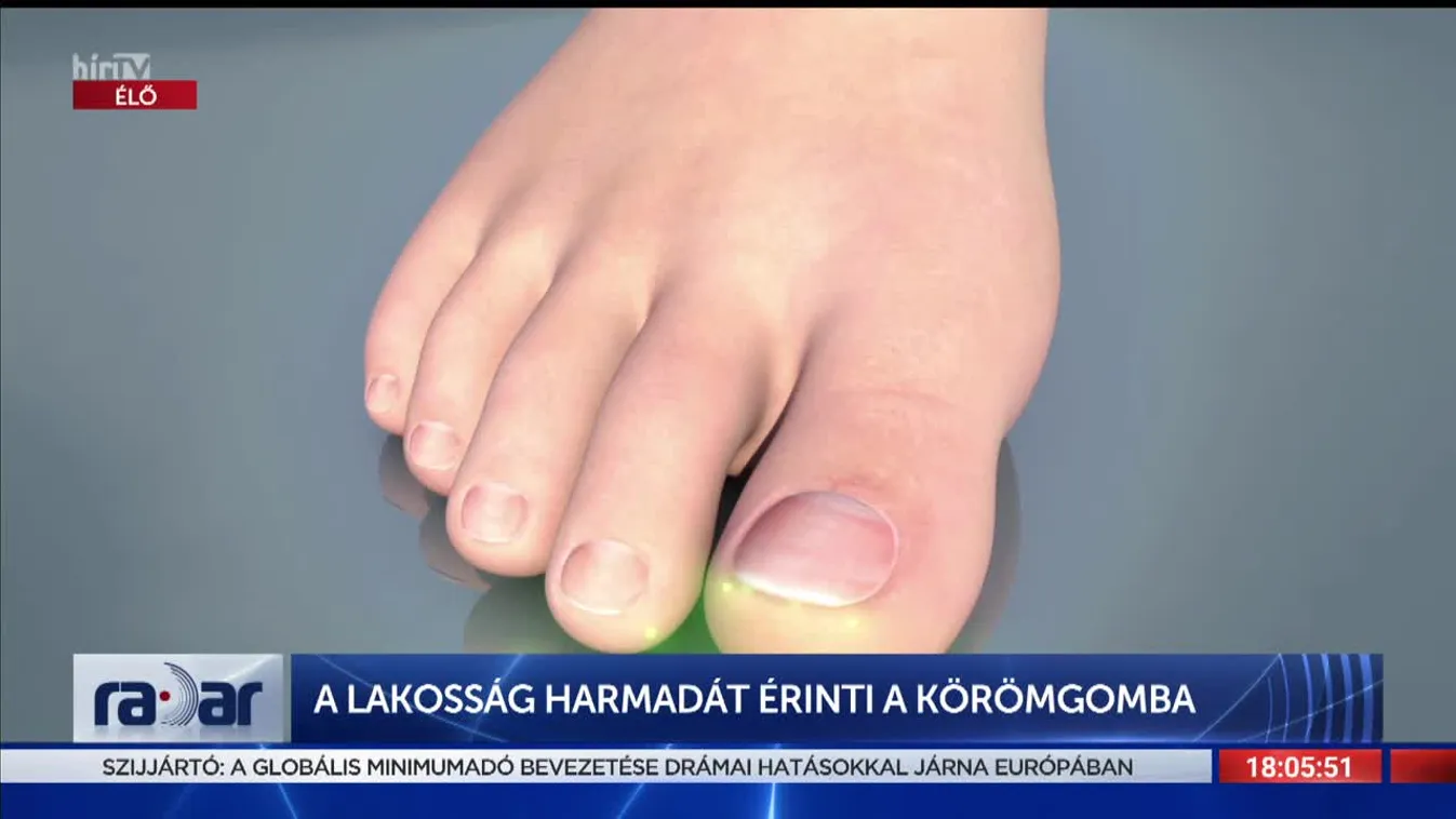Radar - A lakosság harmadát érinti a körömgomba (2022-06-17)