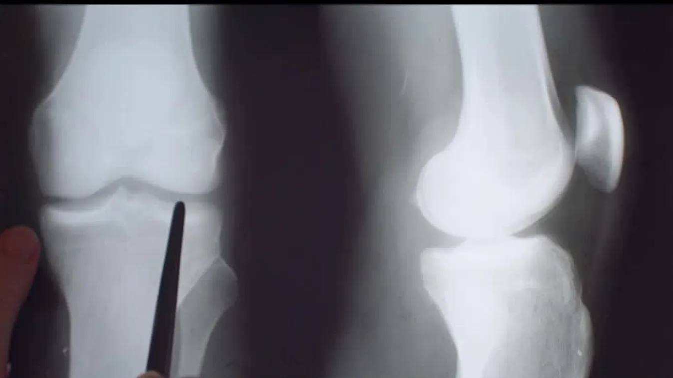 Radar - Lehetséges megoldás ízületi bántalmakra