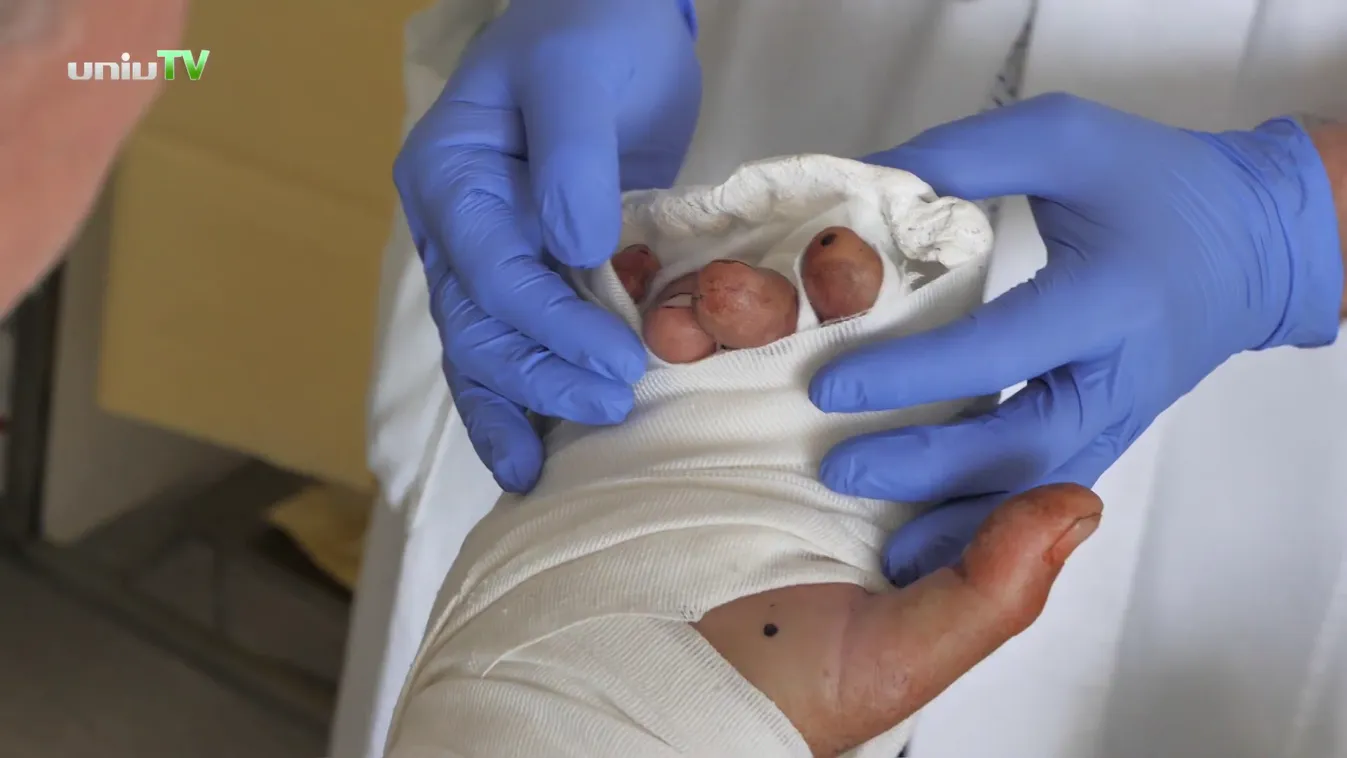 Radar: Bravúros kézvisszaültetés