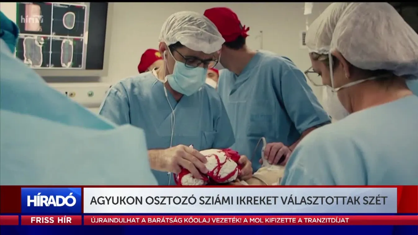 Agyukon osztozó sziámi ikreket választottak szét