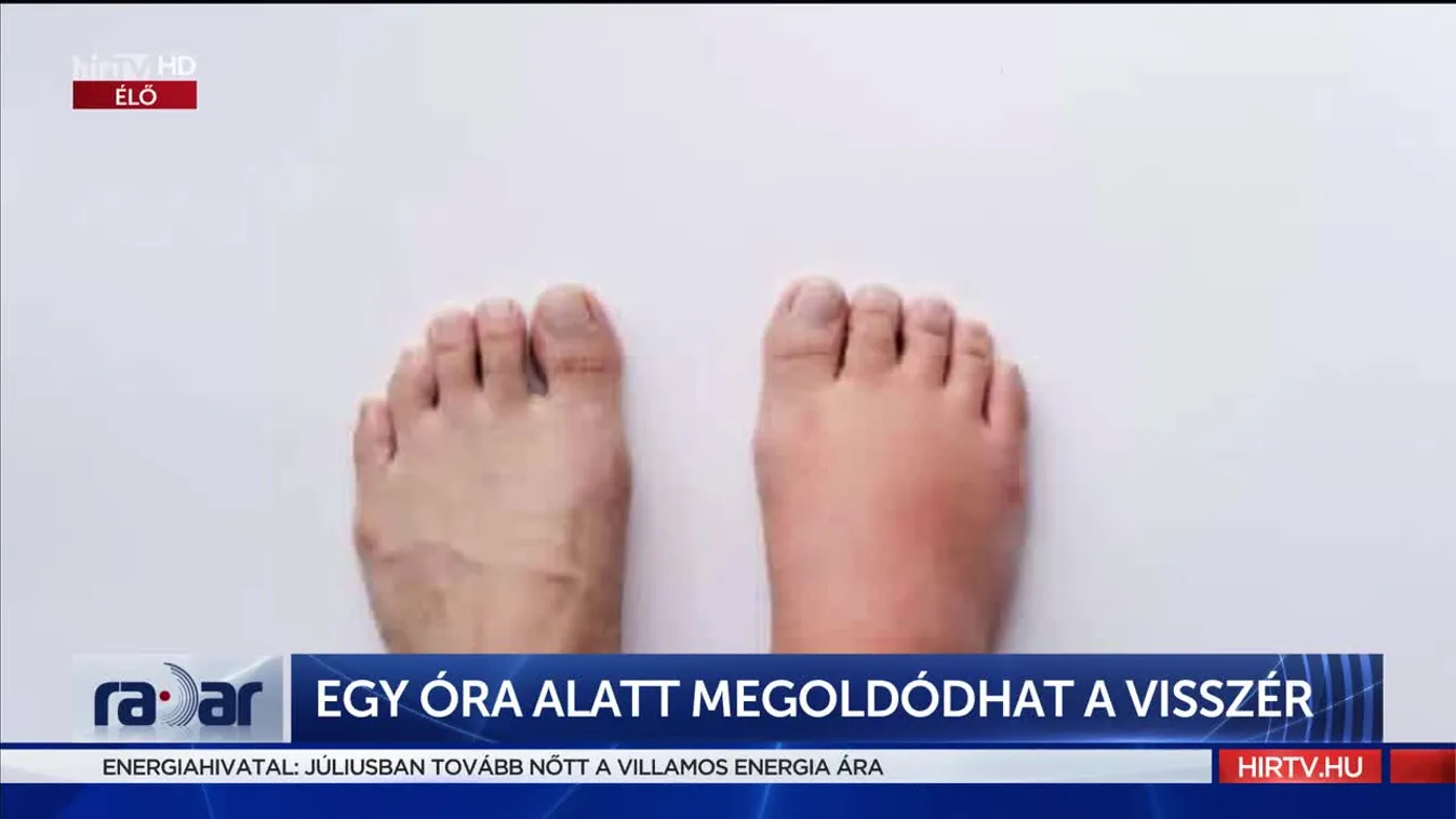 Radar - Egy óra alatt megoldódhat a visszér (2022-08-25)