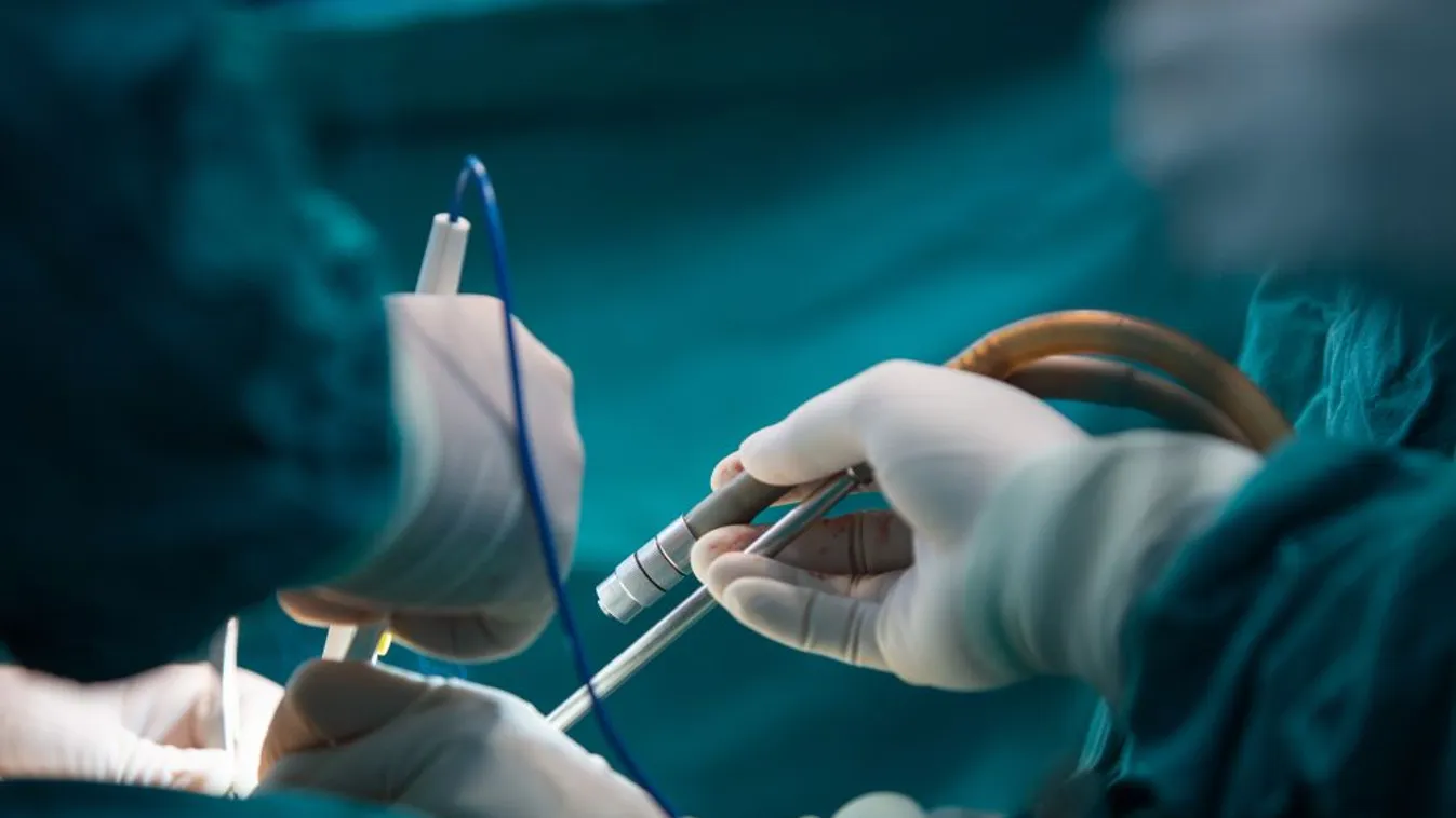 Újabb műtétet végeztek a szétválasztott bangladesi ikerlányok egyikén