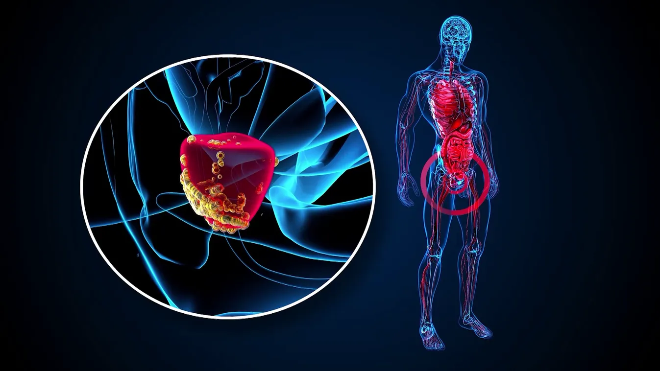 Radar - Örökölhetők a daganatot okozó gének?