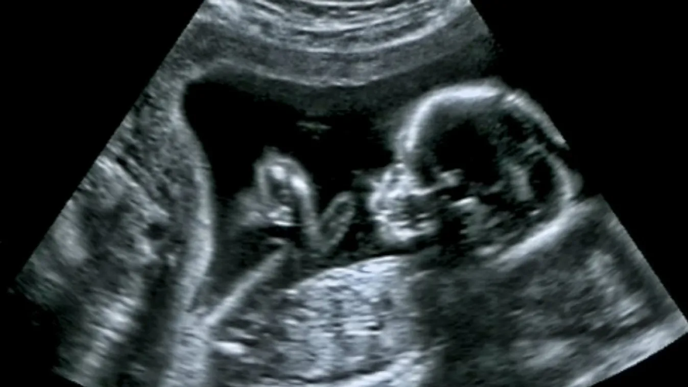 Egyházi tiltakozás ellenére foglalta alkotmányba Franciaország  az „abortuszhoz való jogot”