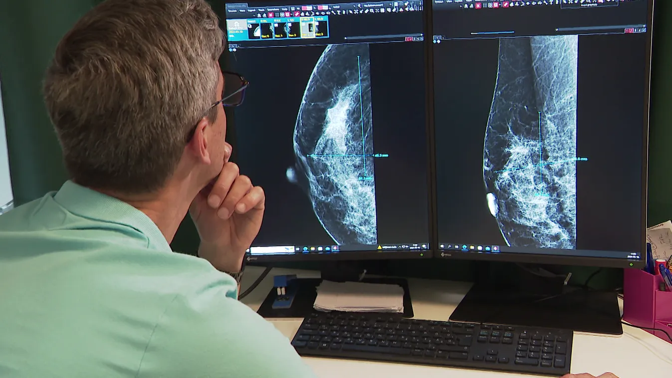 Radar - Mellrák - a többség nem él a szűrés lehetőségével + videó