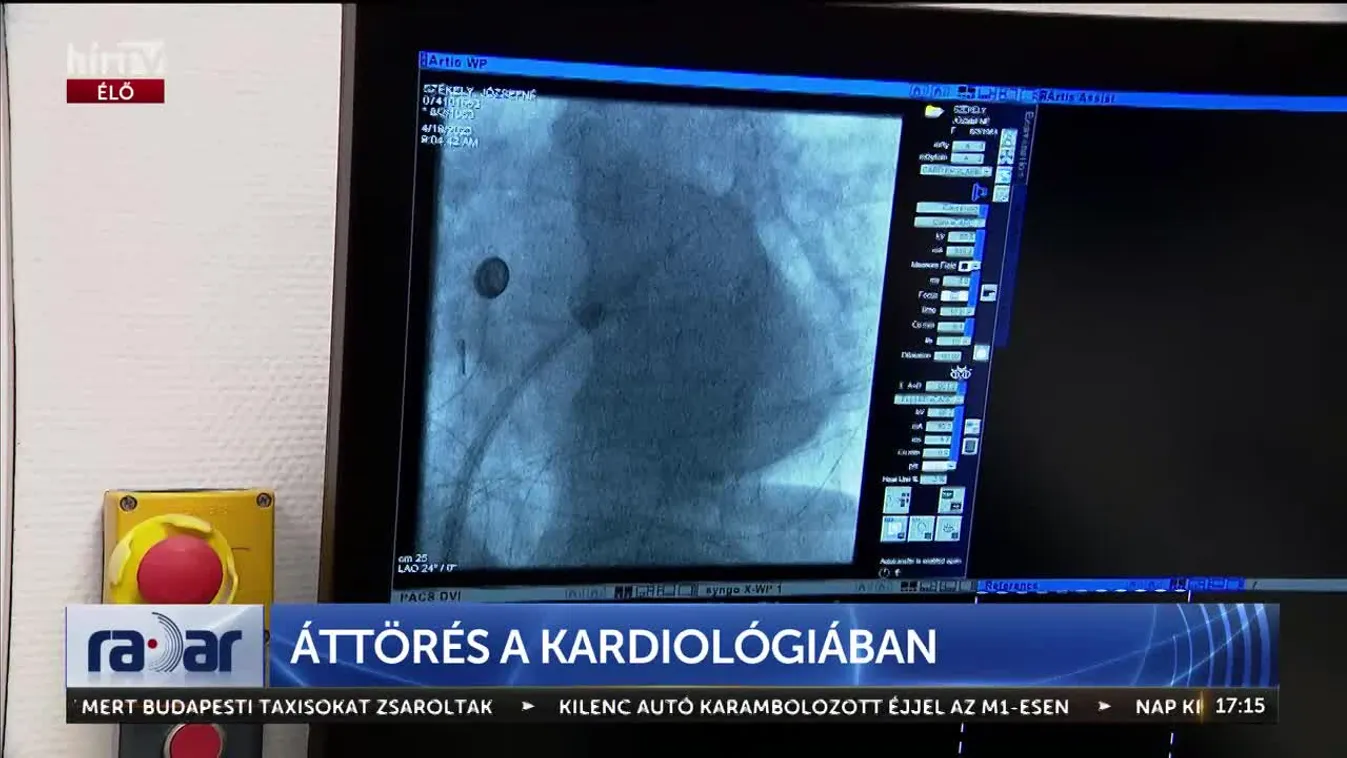 Radar - Áttörés a kardiológiában (2024-07-18)