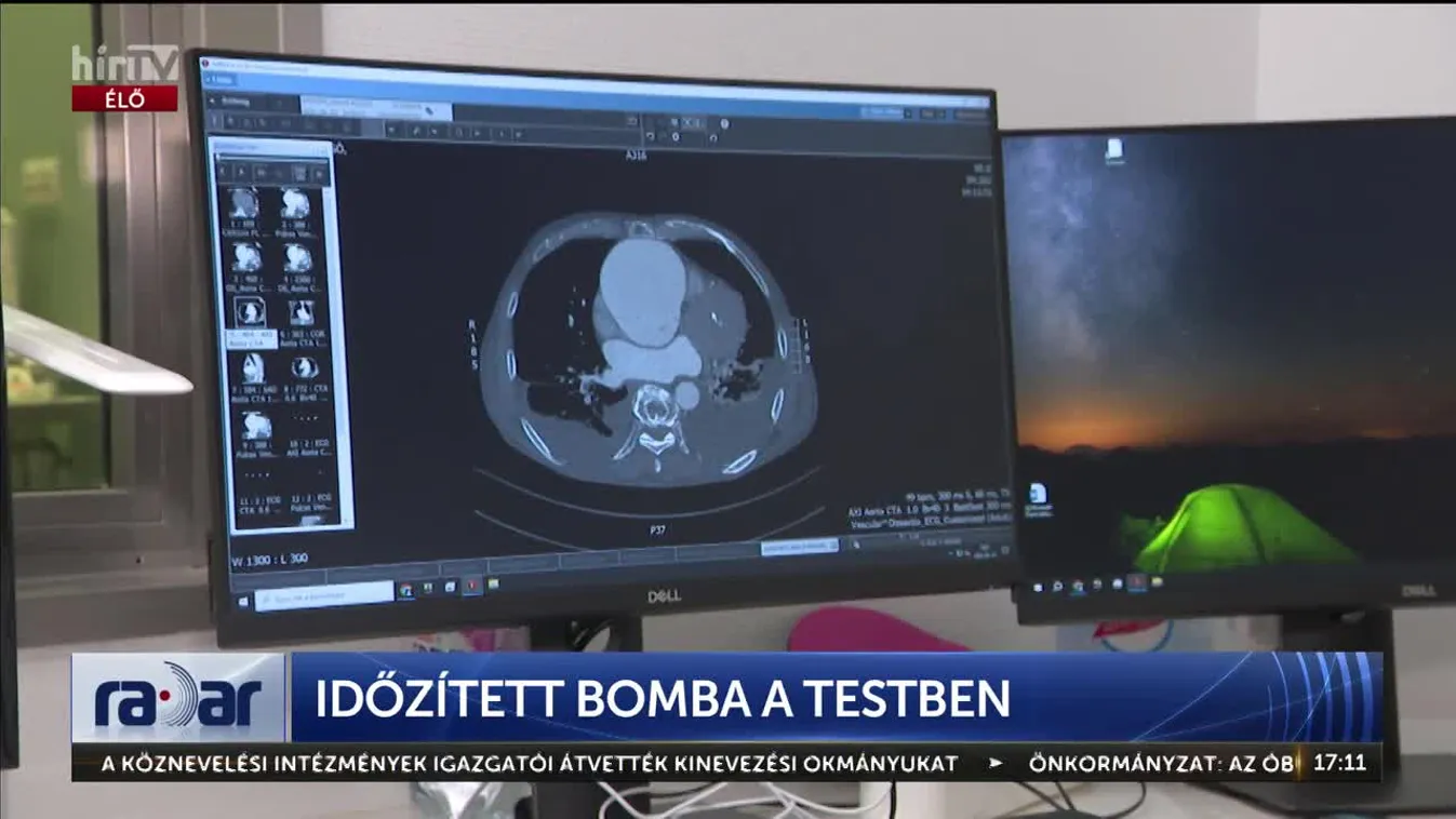 Radar - Időzített bomba a testben (2024-08-22)