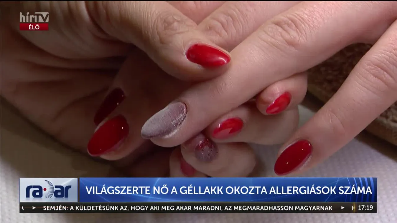 Radar - Világszerte nő a géllakk okozta allergiások száma