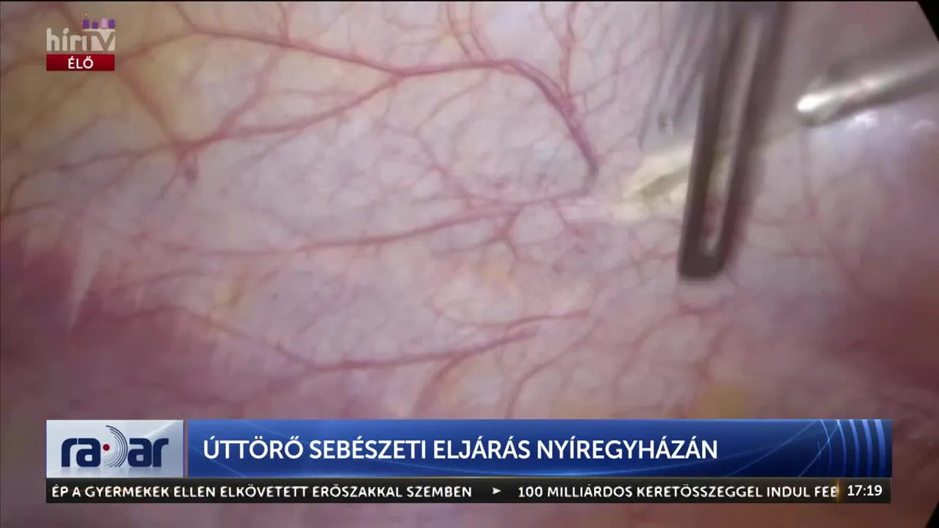 Radar - Úttörő sebészeti eljárás Nyíregyházán (2024-12-04)