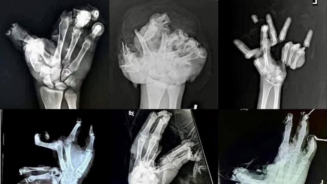 Elrémisztő fotókkal mutatja meg a mentőszolgálat, miért nem éri meg petárdászni