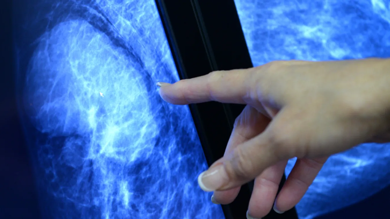 Emlődaganatok korai felismerésére fejlesztenek új diagnosztikai eszközt szegedi kutatók
