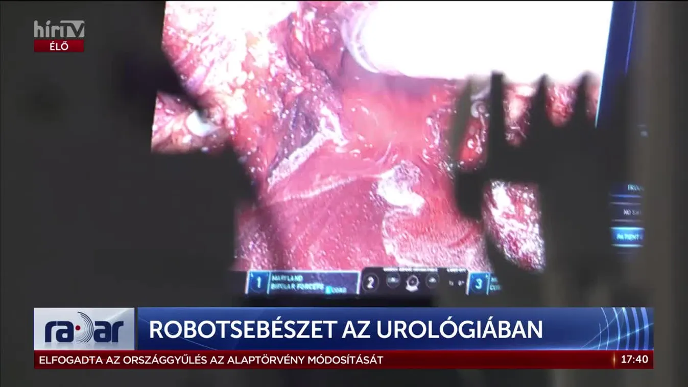 Radar - ROBOTSEBÉSZET AZ UROLÓGIÁBAN