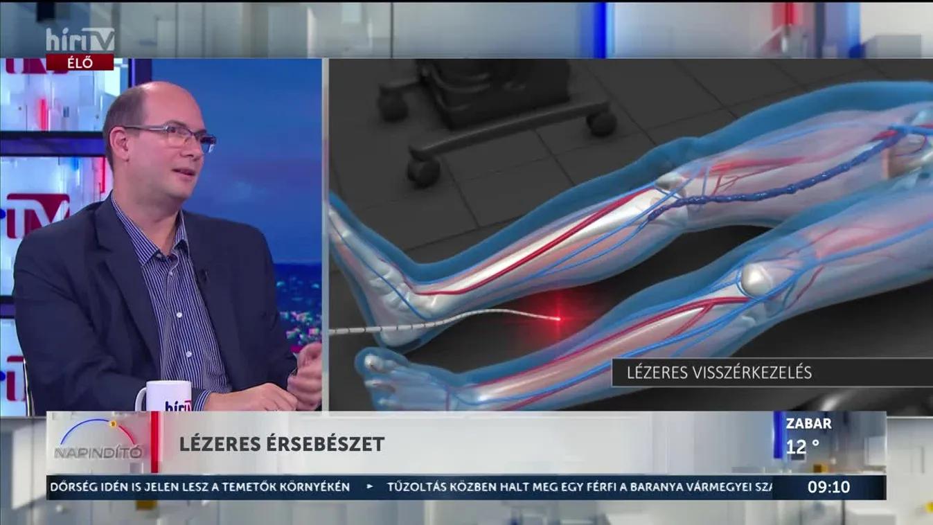 Búcsú a visszerektől? A lézeres érsebészet forradalma + videó