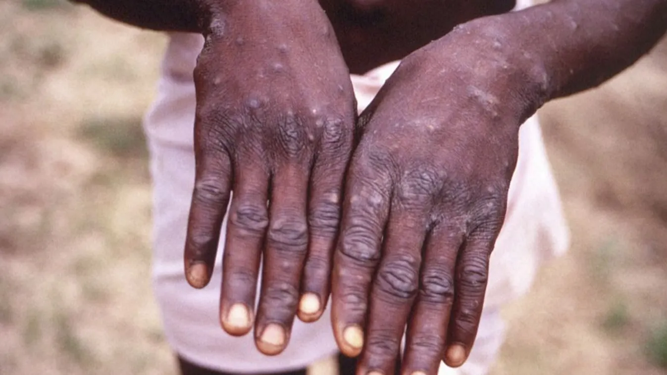 Radar - Már a szomszédban a majomhimlő