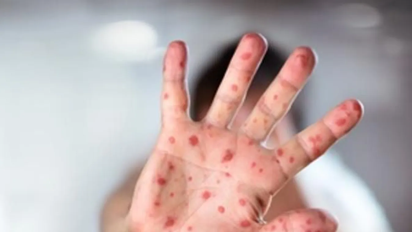 Folyamatosan terjed a kanyaró az USA-ban