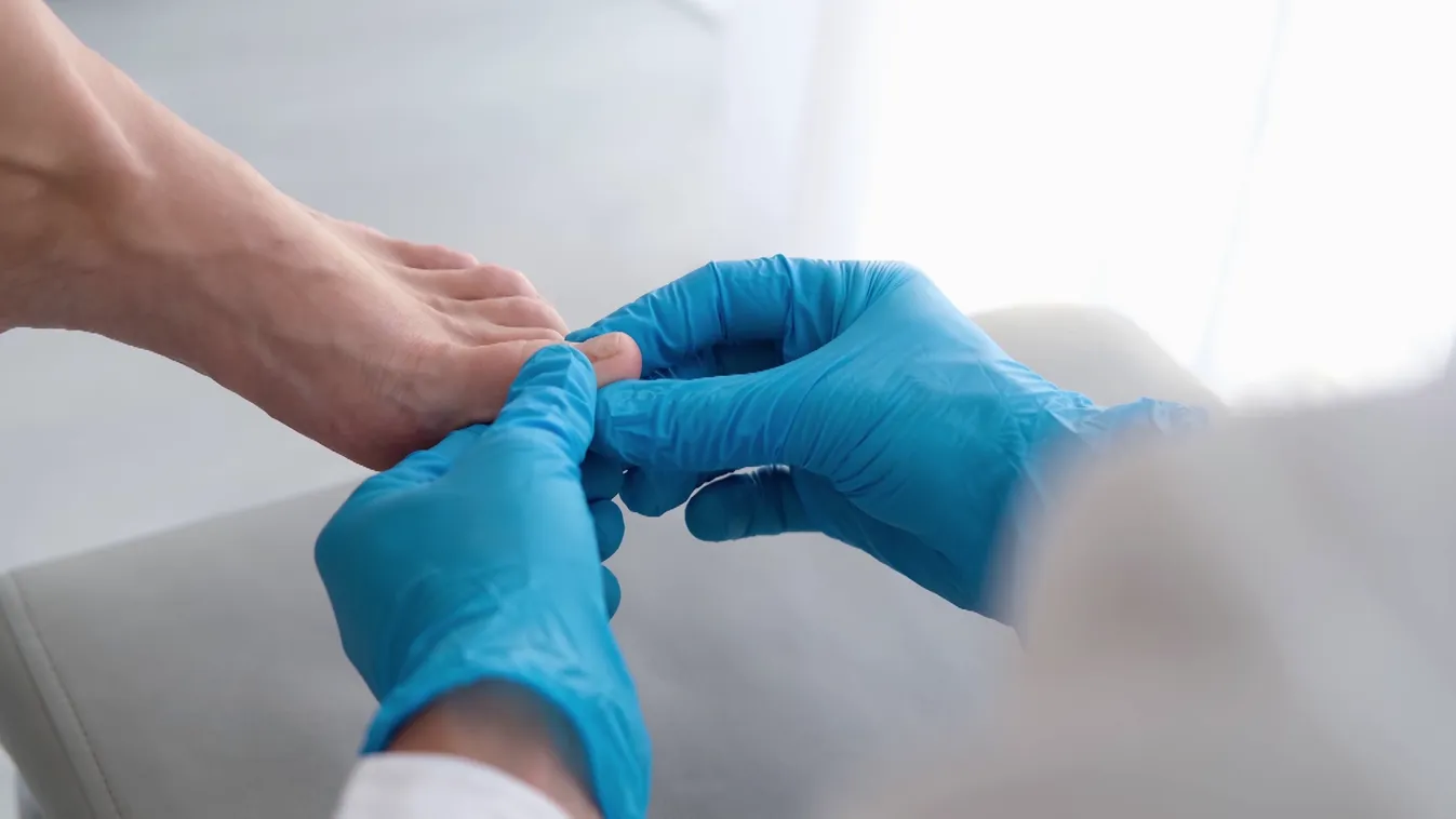 Radar - A lakosság harmadát érinti a körömgomba