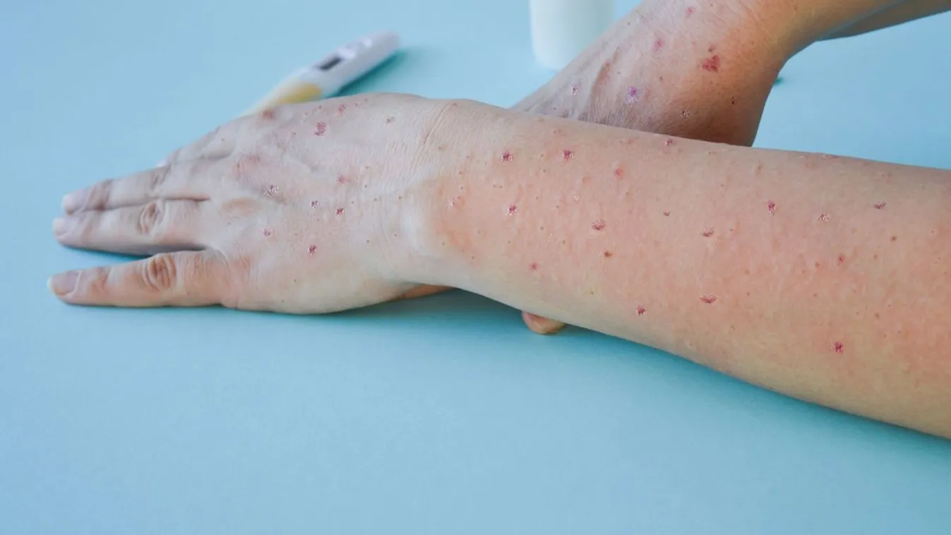 NNK: Újabb majomhimlő-fertőzöttet azonosítottak Magyarországon