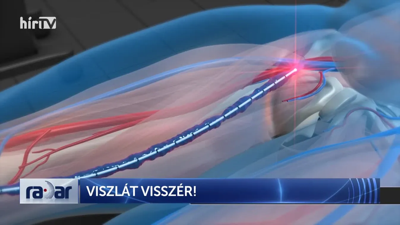 Radar - Viszlát visszér + videó