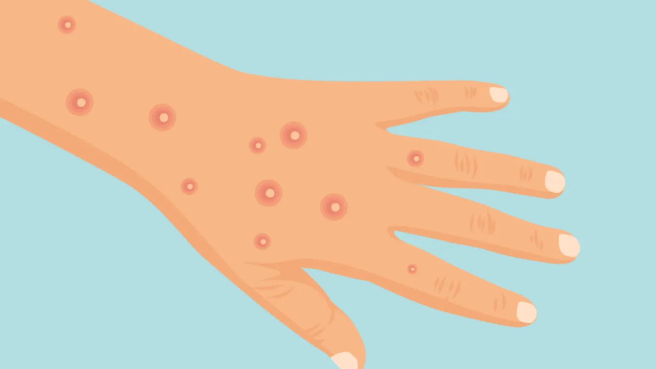 A WHO engedélyezi egy dán oltóanyaggyártó majomhimlő elleni vakcináját