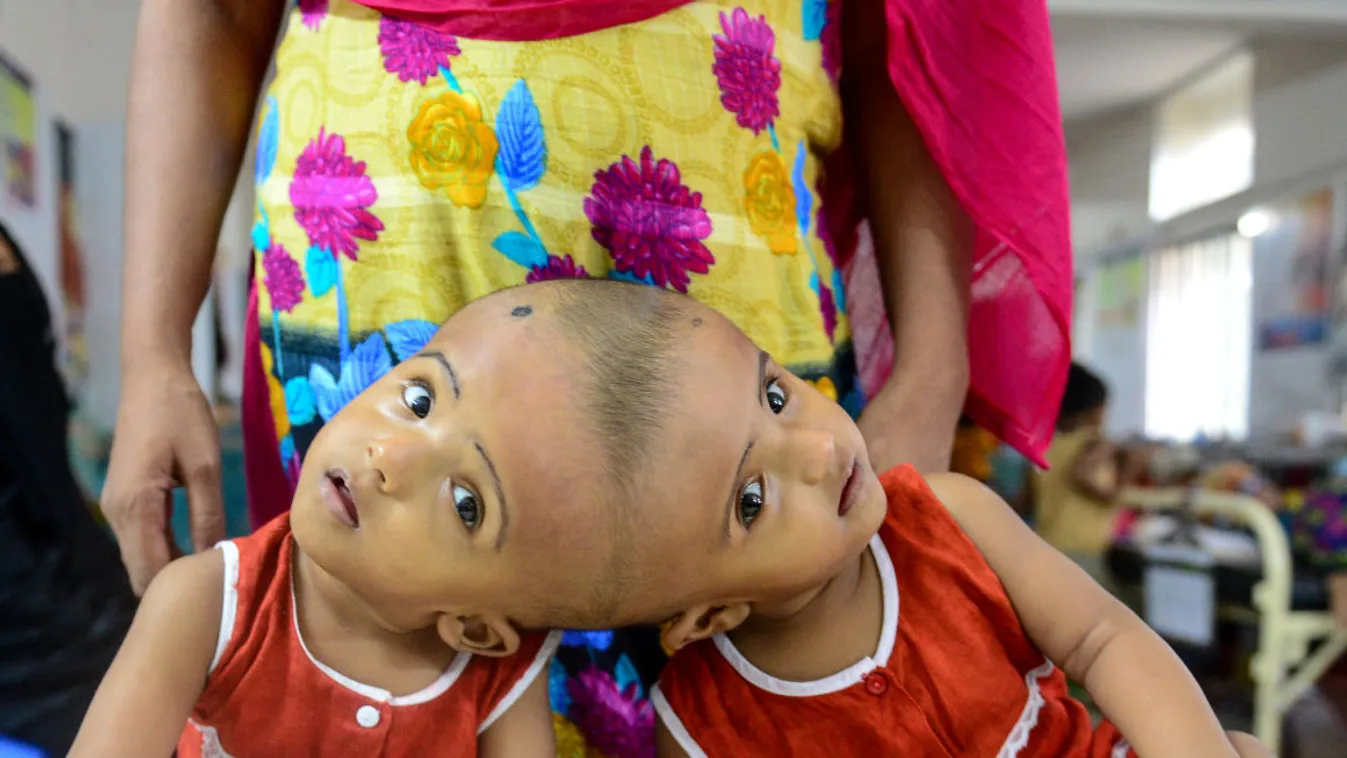 Sikeresen szétválasztották a fejüknél összenőtt bangladesi sziámi ikreket