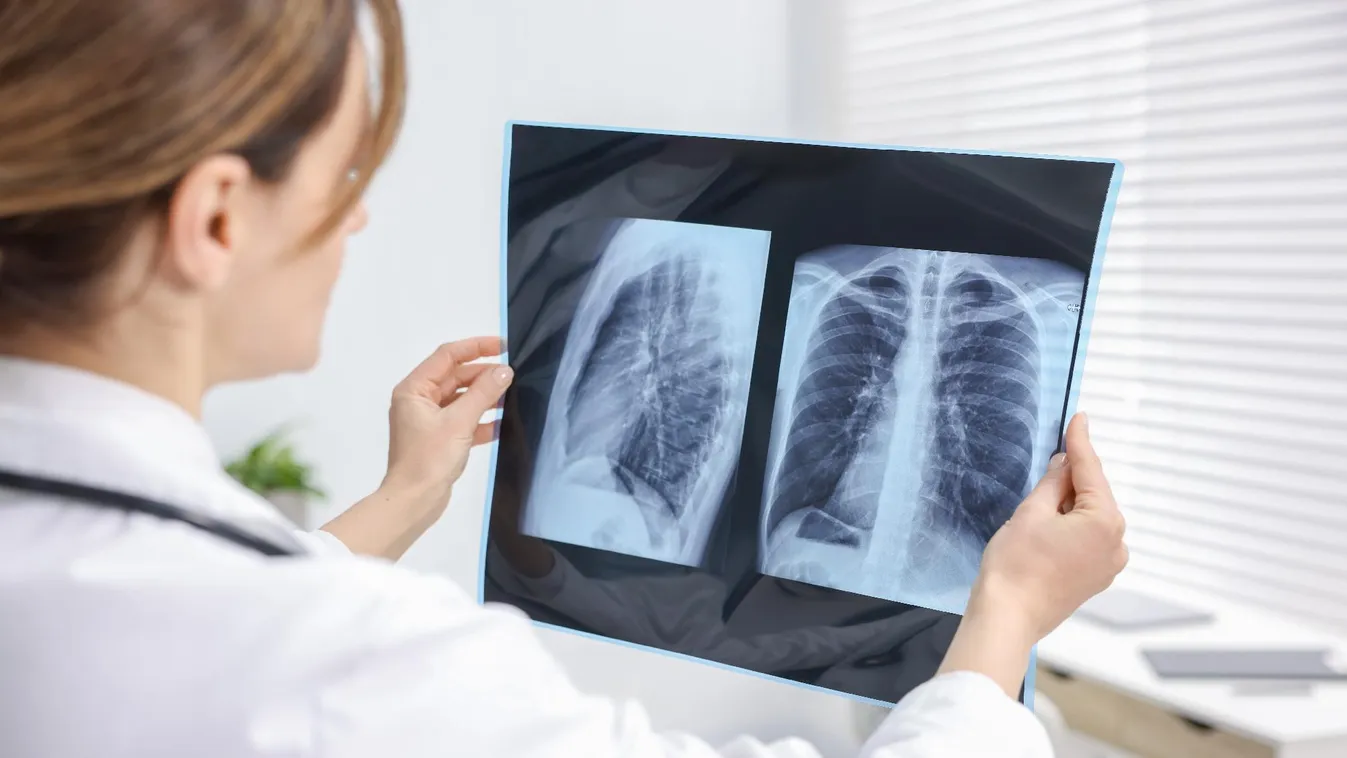 HCEMM: közvetlen kapcsolat lehet a tüdőrák és az emésztőrendszer között