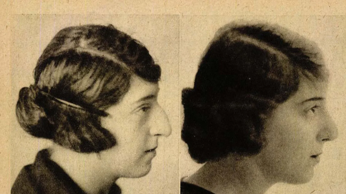 Politikailag (is) pikáns sztorik a magyar plasztikai sebészet hőskorából