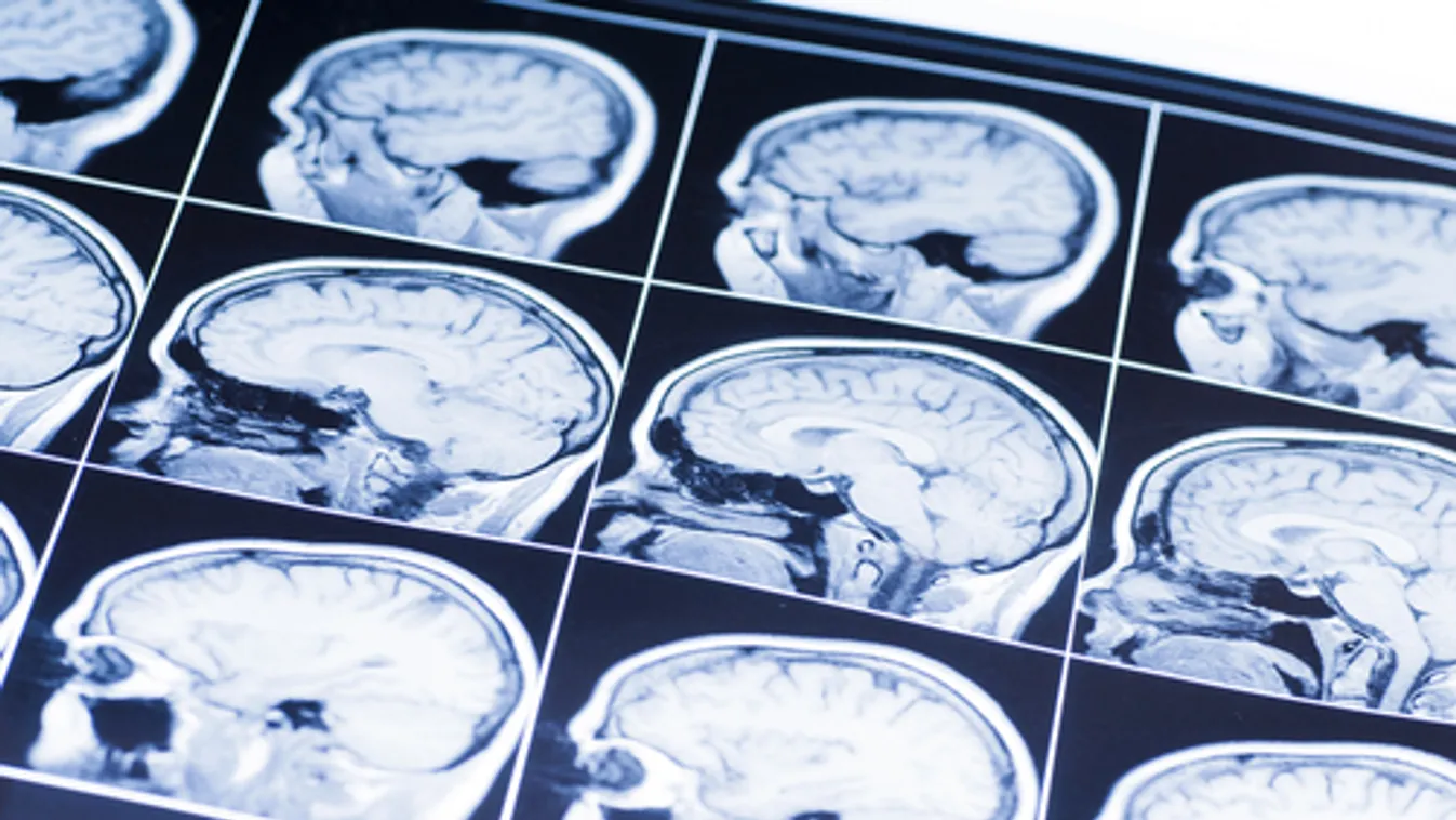 Súlyos agysérülést szenvedtek az amerikai katonák az iráni rakétatámadásban