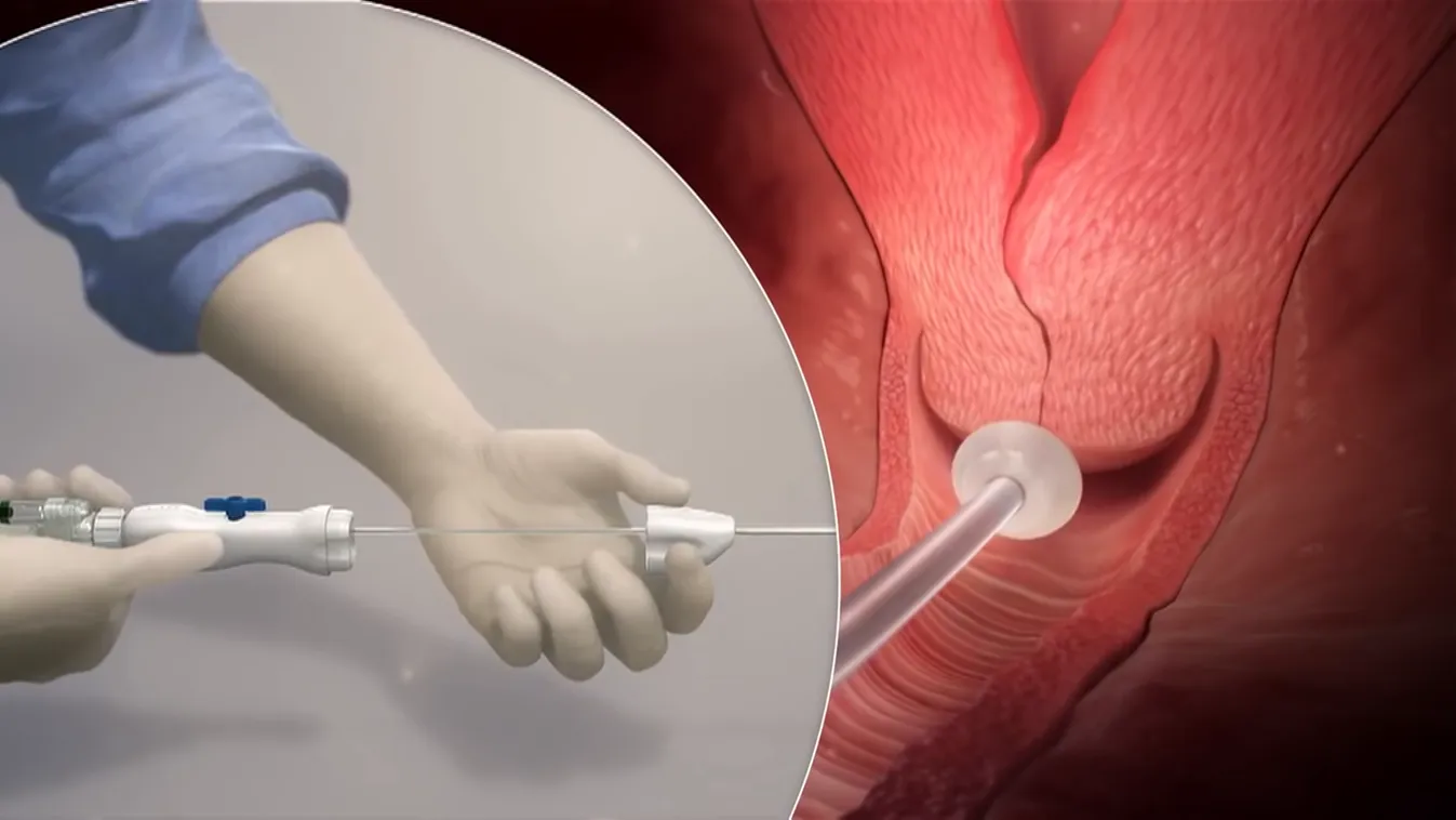 Radar - Mától változik az abortusz törvény