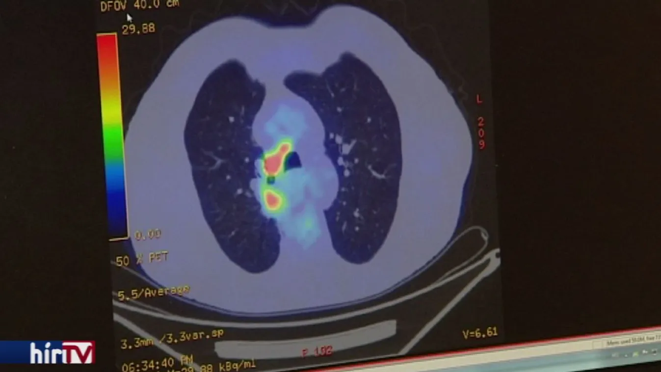 Továbbra is Magyarországon a legtöbb a tüdőrákos az EU-ban