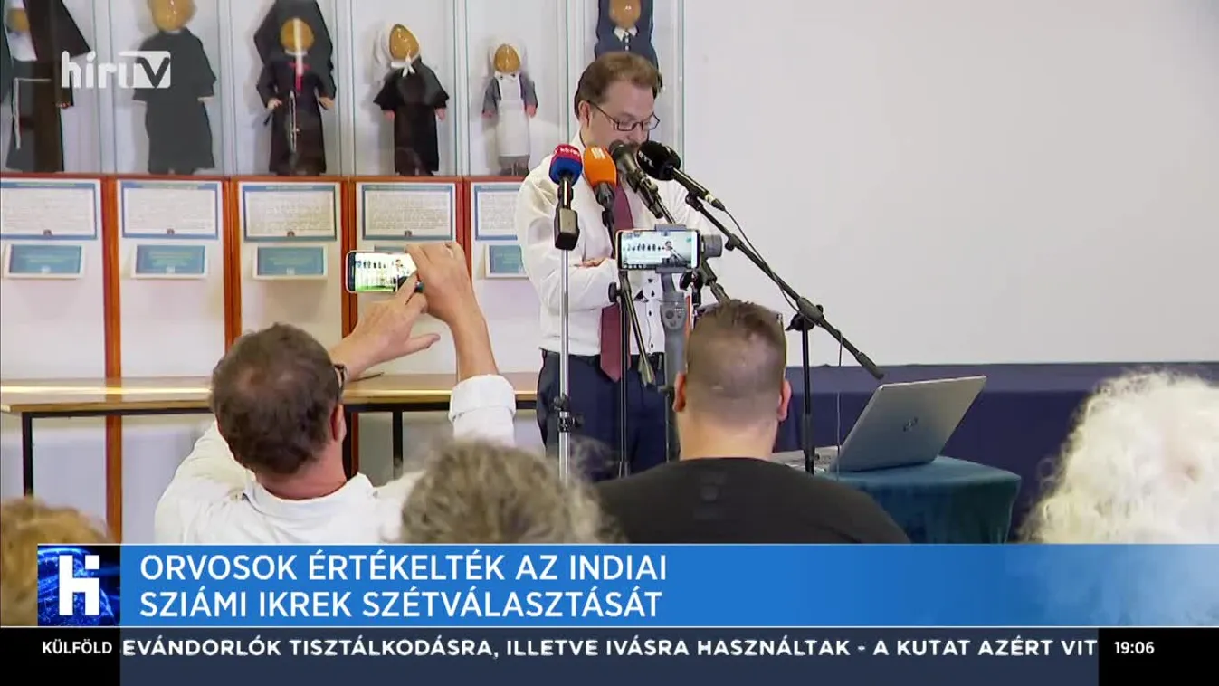 Orvosok értékelték az indiai sziámi ikrek szétválasztását
