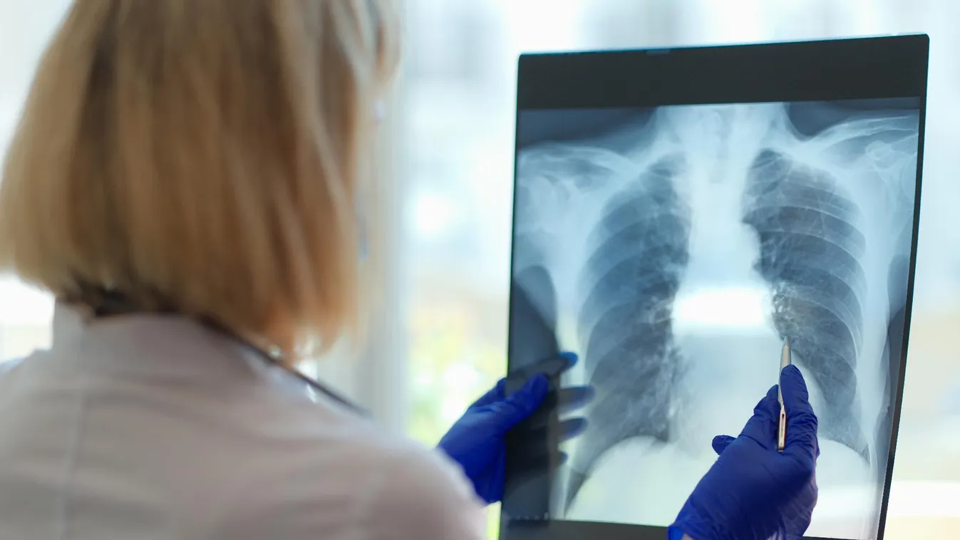 Sikeres tüdőtranszplantációt hajtottak végre egy magyar gyermeken