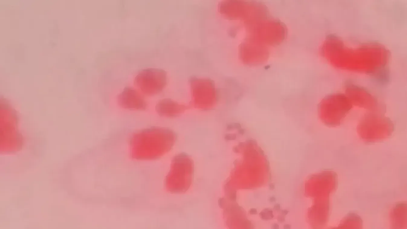 Növekszik az agyhártyagyulladásban szenvedők száma Angliában