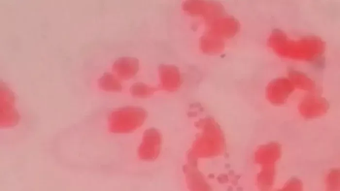 Növekszik az agyhártyagyulladásban szenvedők száma Angliában